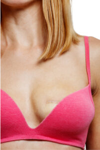 mastectomy care